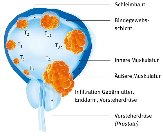 Illustration: Tumorausdehnung und Stadieneinteilung bei Blasenkrebs