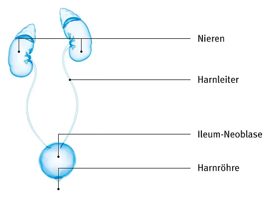 Illustration: Ileum-Neoblase