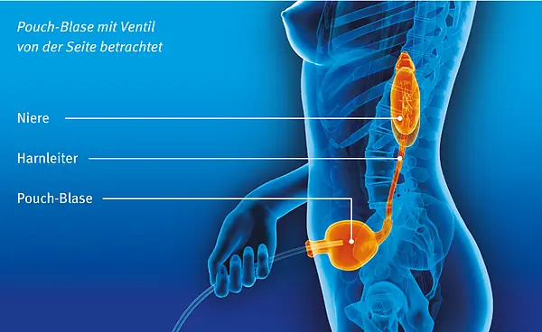 Illustration: Pouch-Blase mit Ventil von der Seite betrachtet
