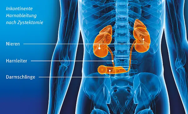 Illustration: Beim Ileum conduit werden die Harnleiter in eine ausgeschaltete Darmschlinge eingenäht. Die Darmschlinge wird als Stoma in die Haut genäht. Der Urin wird über einen Stomabeutel gesammelt.